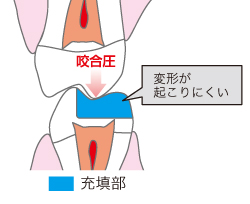 充填部イラスト