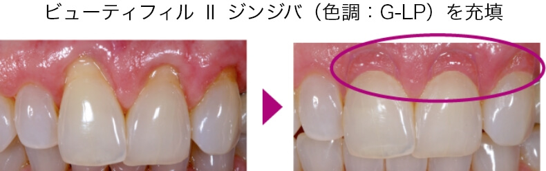 ビューティフィル Ⅱ ジンジバ（色調：G-LP）を充填