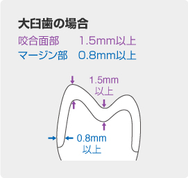 支台歯形成のポイント | 松風ブロックHCスーパーハード | 株式会社 松風