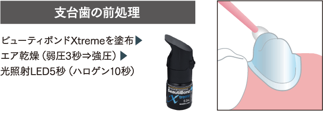 支台歯の前処理