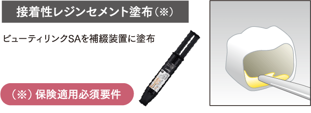 接着性レジンセメント塗布