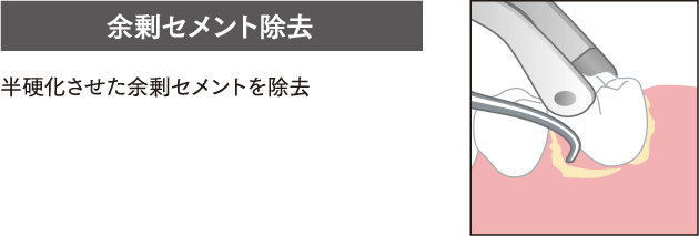 余剰セメント除去