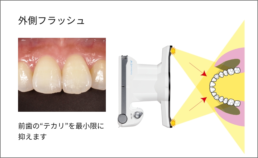 外側フラッシュ 前歯の“テカリ”を最小限に抑えます