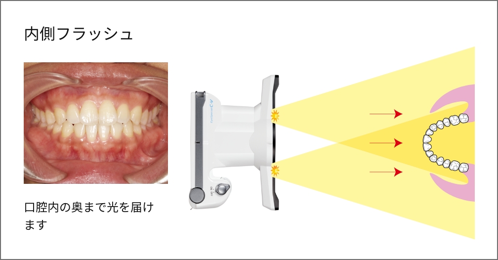 内側フラッシュ 口腔内の奥まで光を届けます