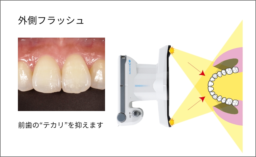 外側フラッシュ 前歯の“テカリ”を最小限に抑えます