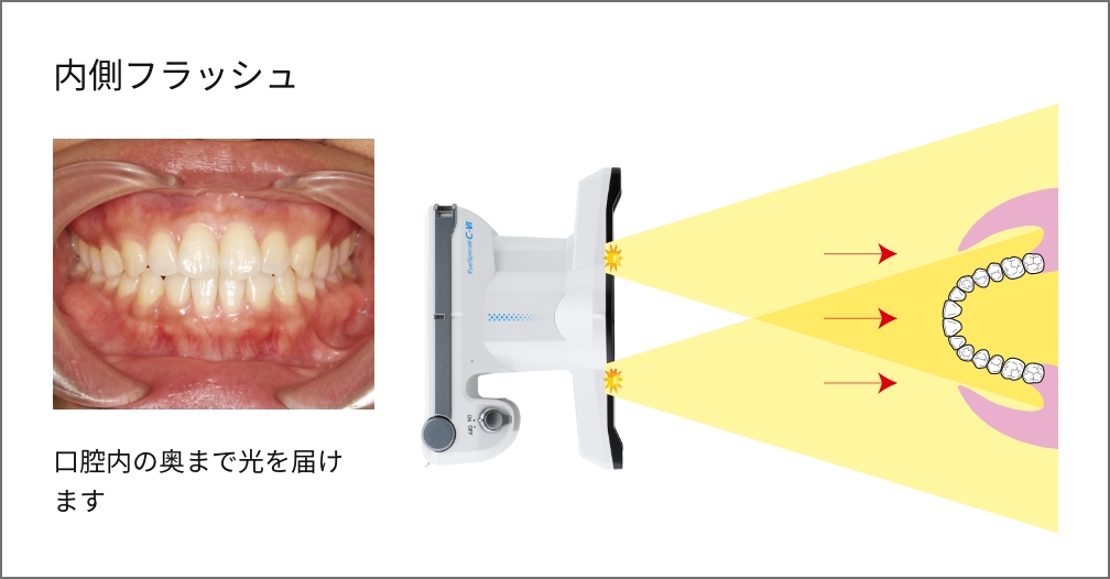 内側フラッシュ 口腔内の奥まで光を届けます