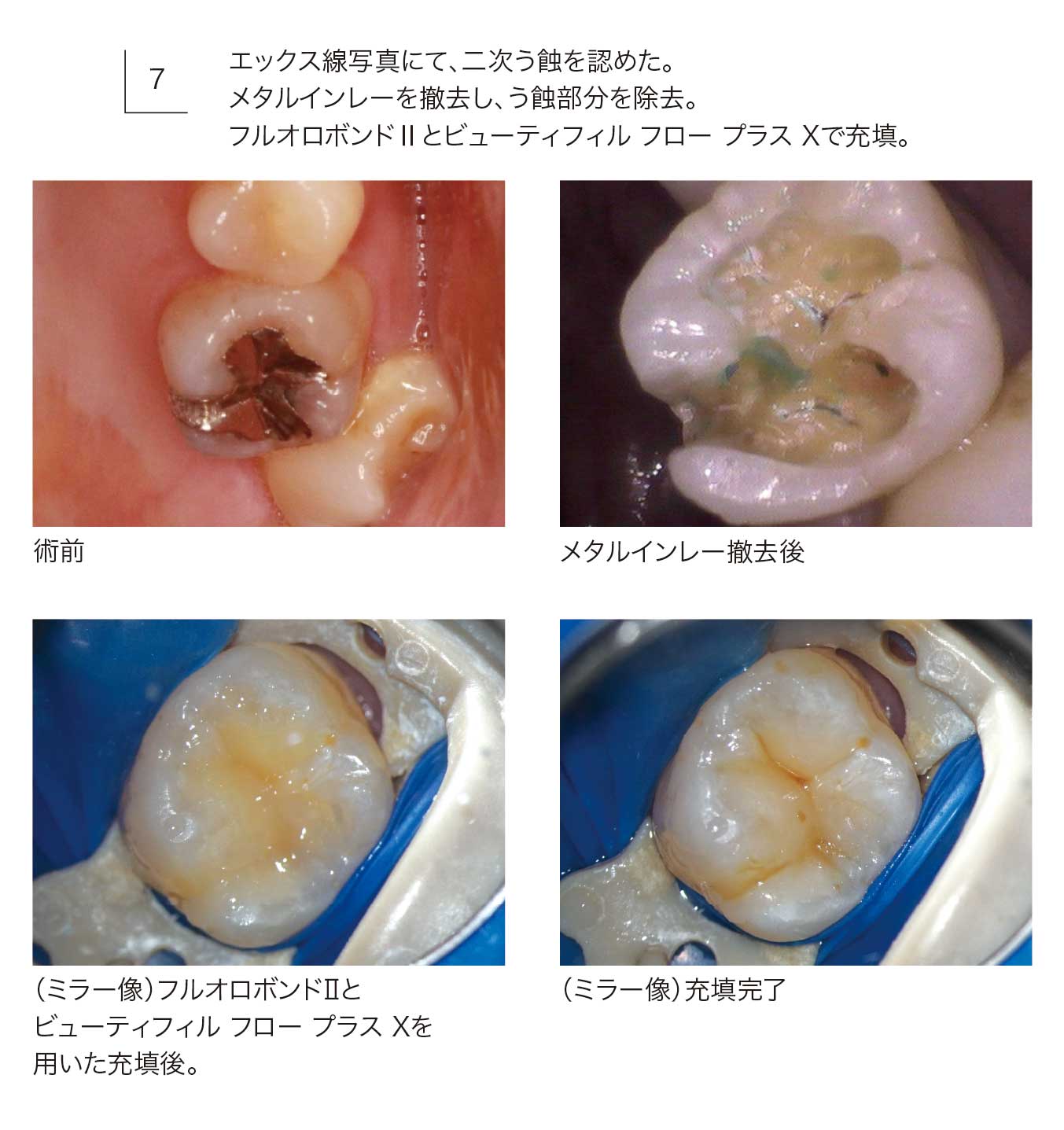 フルオロボンドⅡ