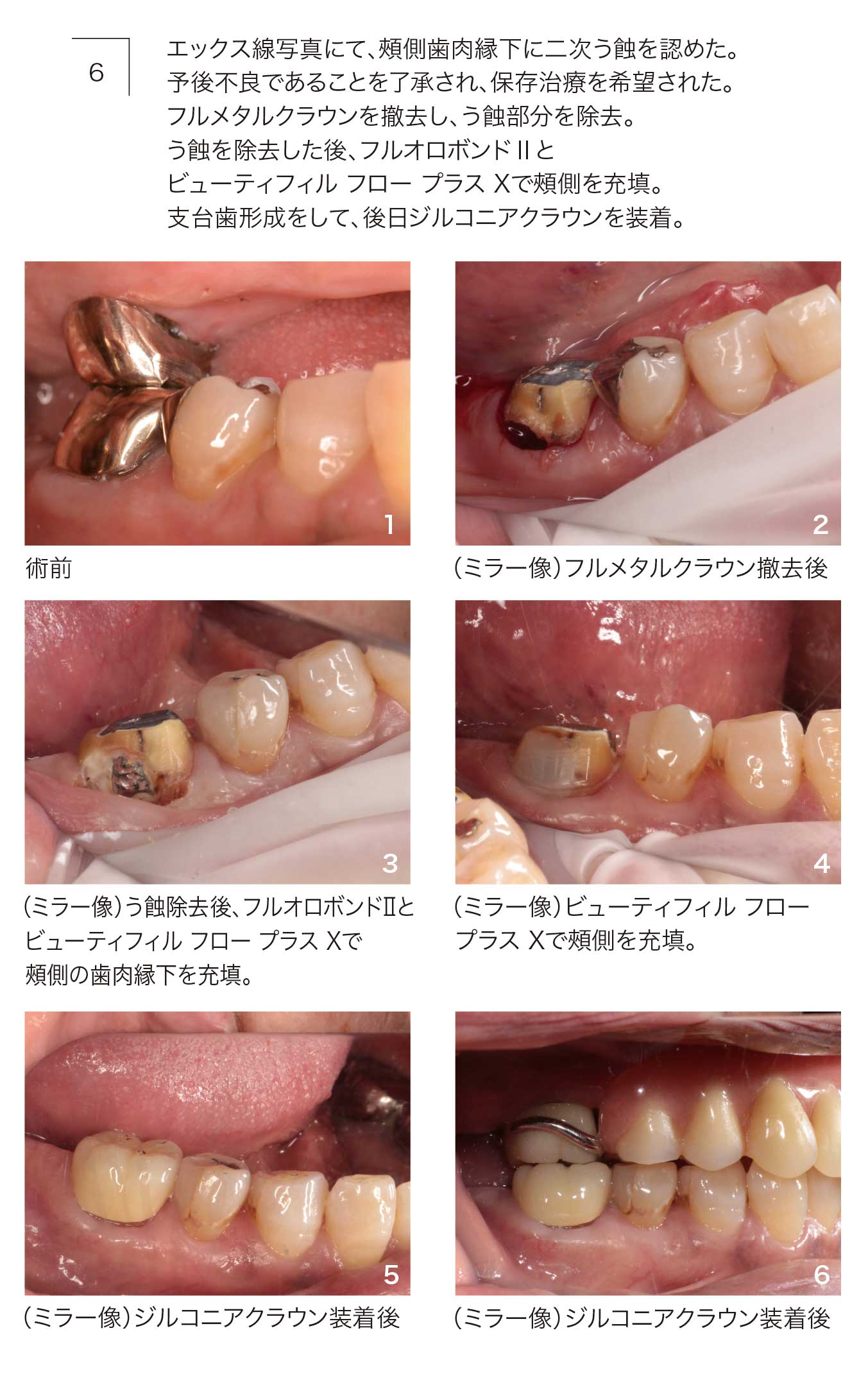 フルオロボンドⅡ