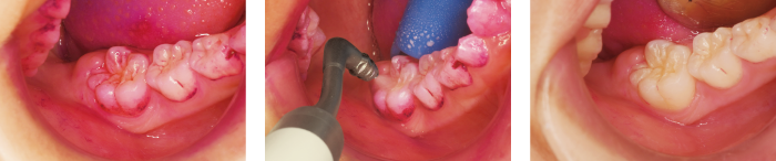 メルサージュエピックパウダーペリオ使用例：咬合面