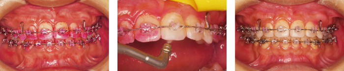 メルサージュエピックパウダーペリオ使用例：矯正治療中