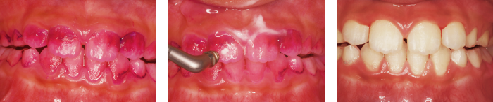 メルサージュエピックパウダーペリオ使用例：小児
