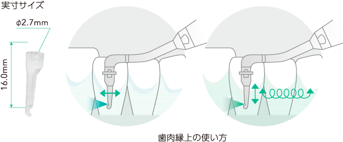 歯肉辺縁への使い方