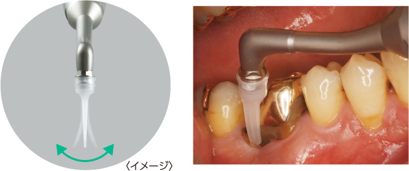 歯肉へのアクセス性を高めた柔軟性のあるプラスチックノズルチップ