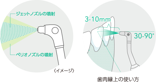 イメージ・歯肉辺縁への使い方