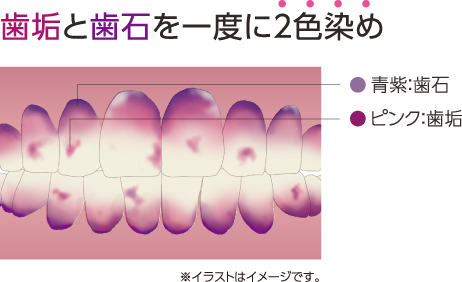歯垢と歯石を一度に２色染め