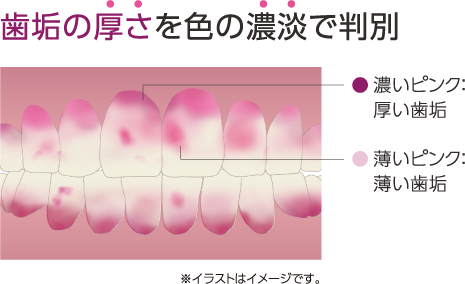歯垢の厚さを色の濃淡で判別