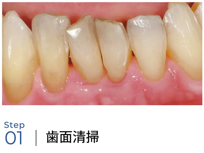 歯面清掃