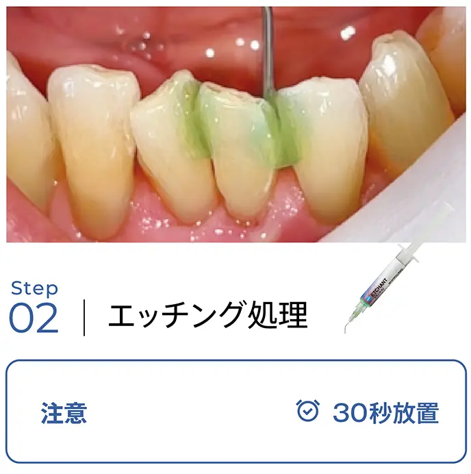 エッチング処理