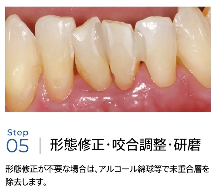形態修正・咬合調整・研磨
