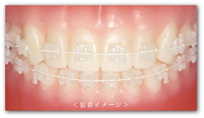 プレシ クリスタル -矯正製品-