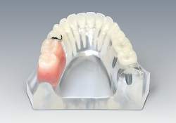 遊離端欠損　インプラントvs部分義歯 