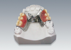 部分金属床義歯 -製品情報2-