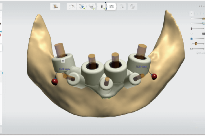 インプラントスタジオ(Implant StudioTM)