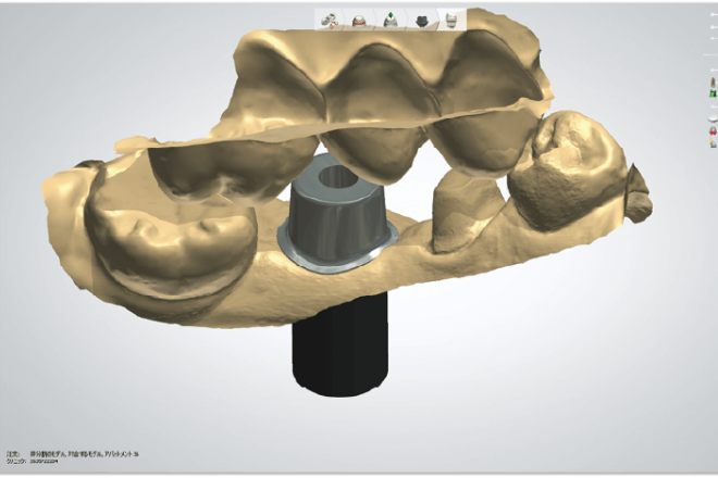 アバットメントデザイナー(Abutment DesignerTM)