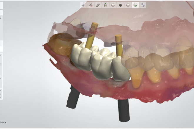 アバットメントデザイナーandインプラントバー&ブリッジ(Abutment Designer and Implant Bar & Bridge)