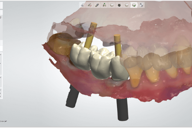  アバットメントデザイナーandインプラントバー＆ブリッジ(Abutment Designer and Implant Bar & Bridge)